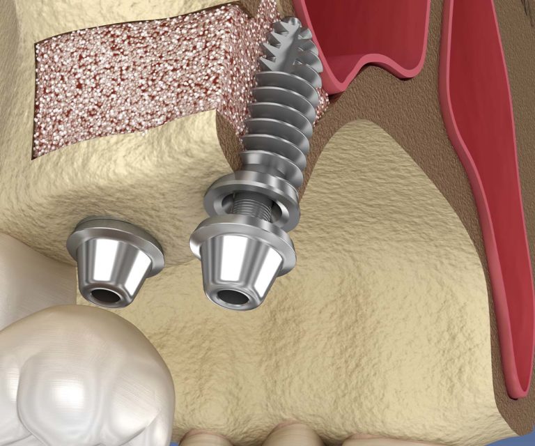 Sinus Lift Zahnarzt Popal